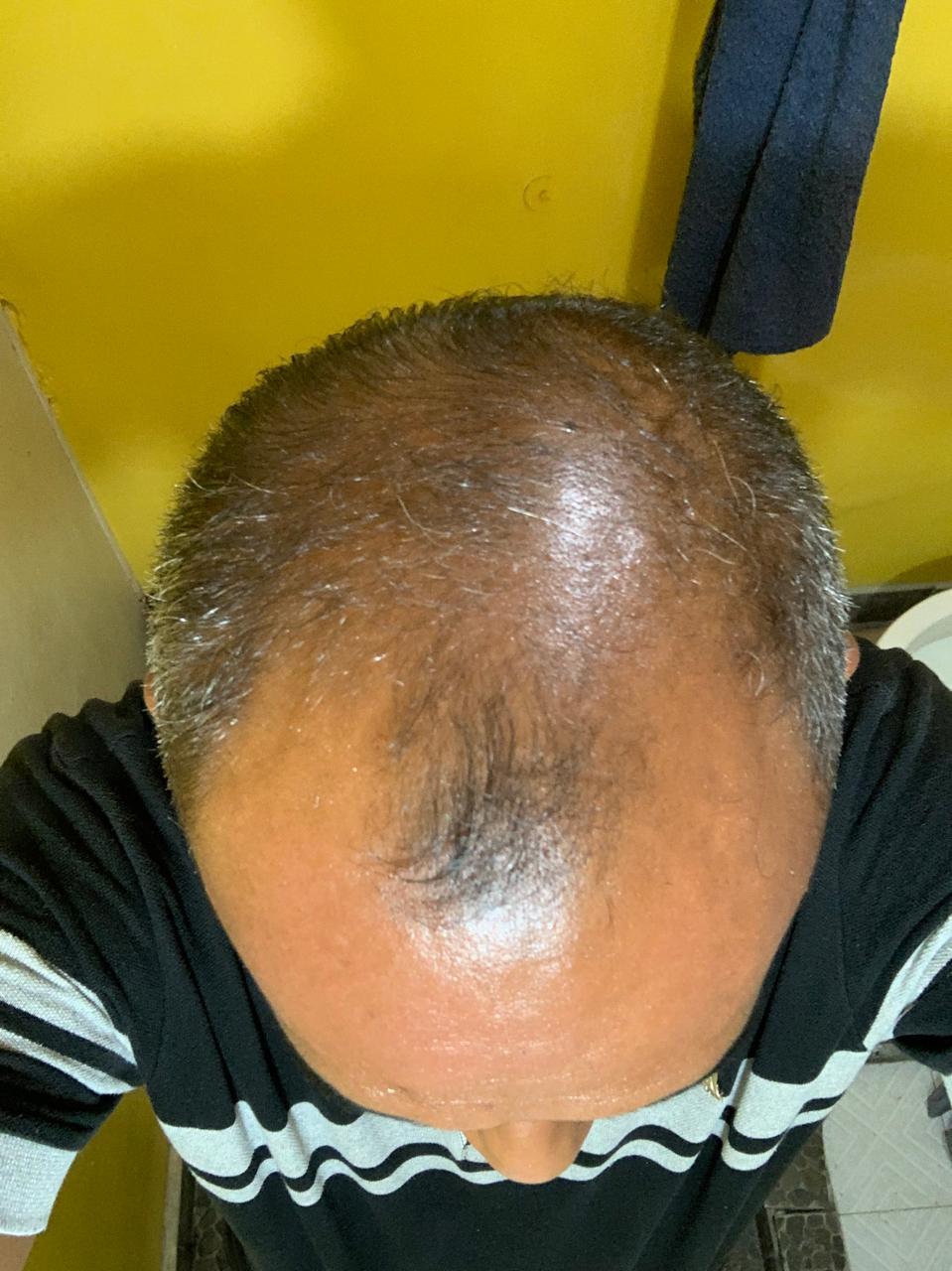 SHAMPO SÓLIDO NATURAL ANTICAIDA DE CABELLO