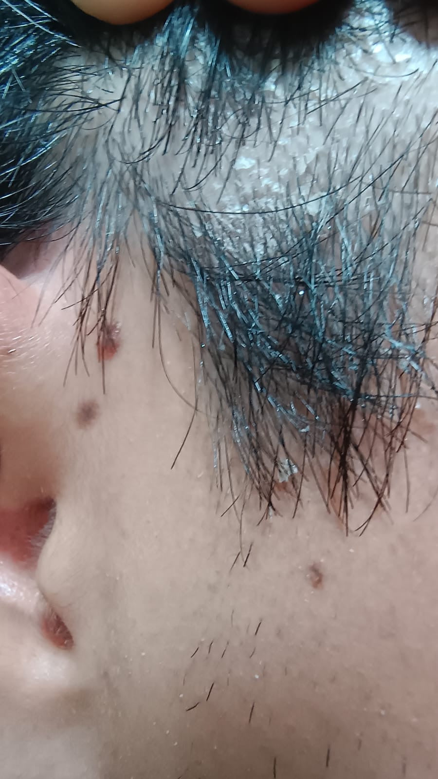 Shampo Sólido Anticaspa-Psoriasis Cinnafix